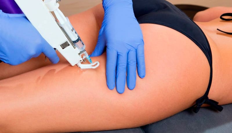 Mesoterapia: O que é, para que serve e quais os efeitos secundários e riscos?