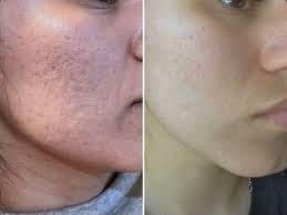 Dermapen Tratamento Acne e Cicatrizes