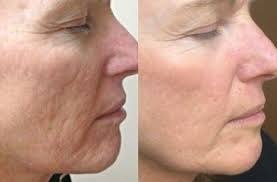 Tratamentos de Rosto e Corpo Avançados - Dermapen Redução de Rugas